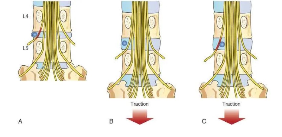 kéo cột sống traction 